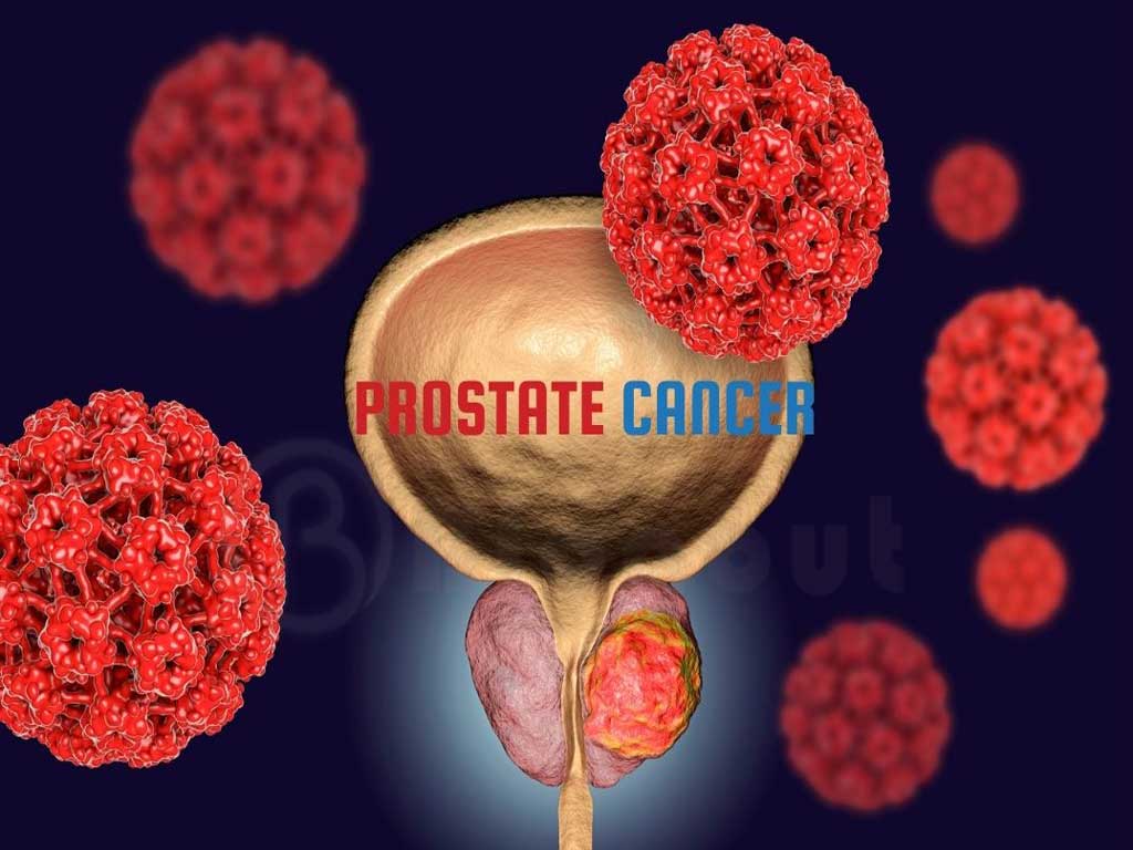 Cause of Prostate Cancer