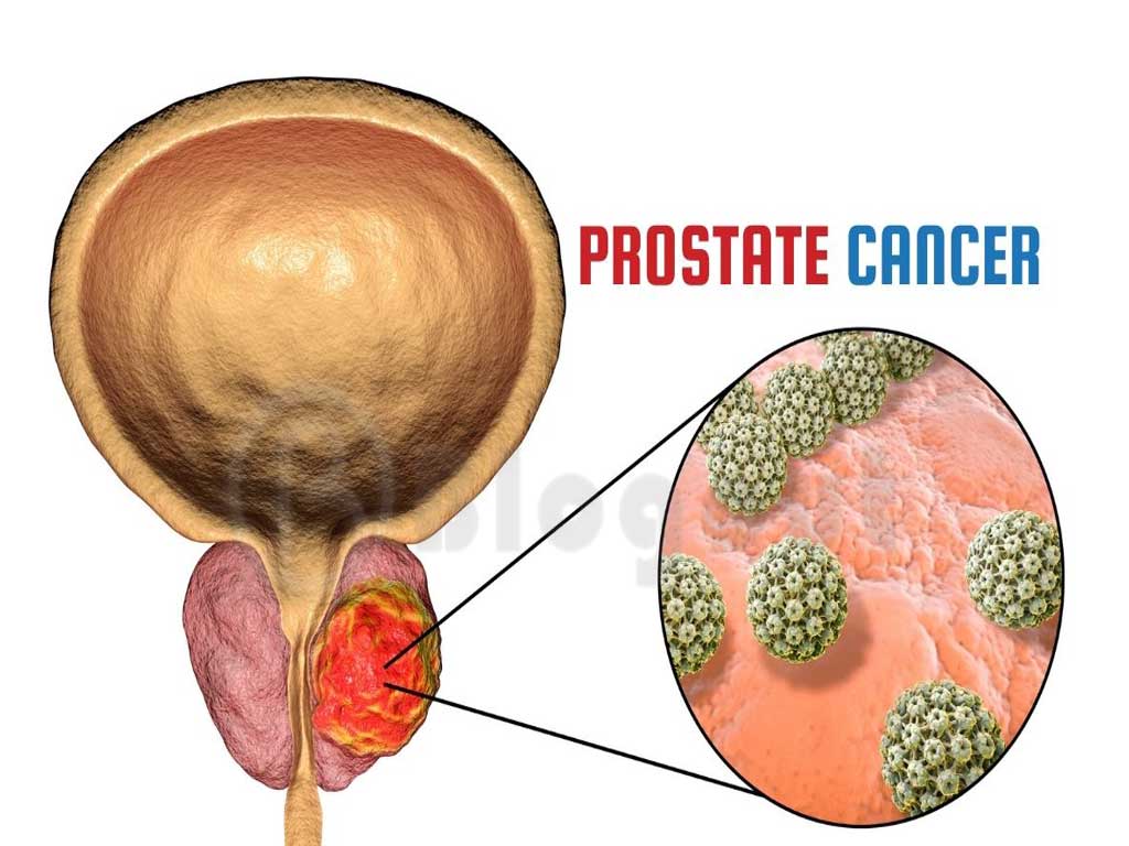 Prostate Cancer