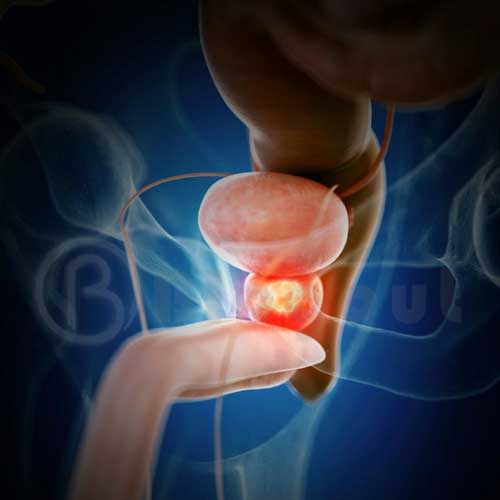 Symptoms of Bladder Cancer