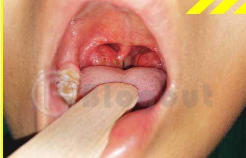 Symptoms of Tonsil Cancer