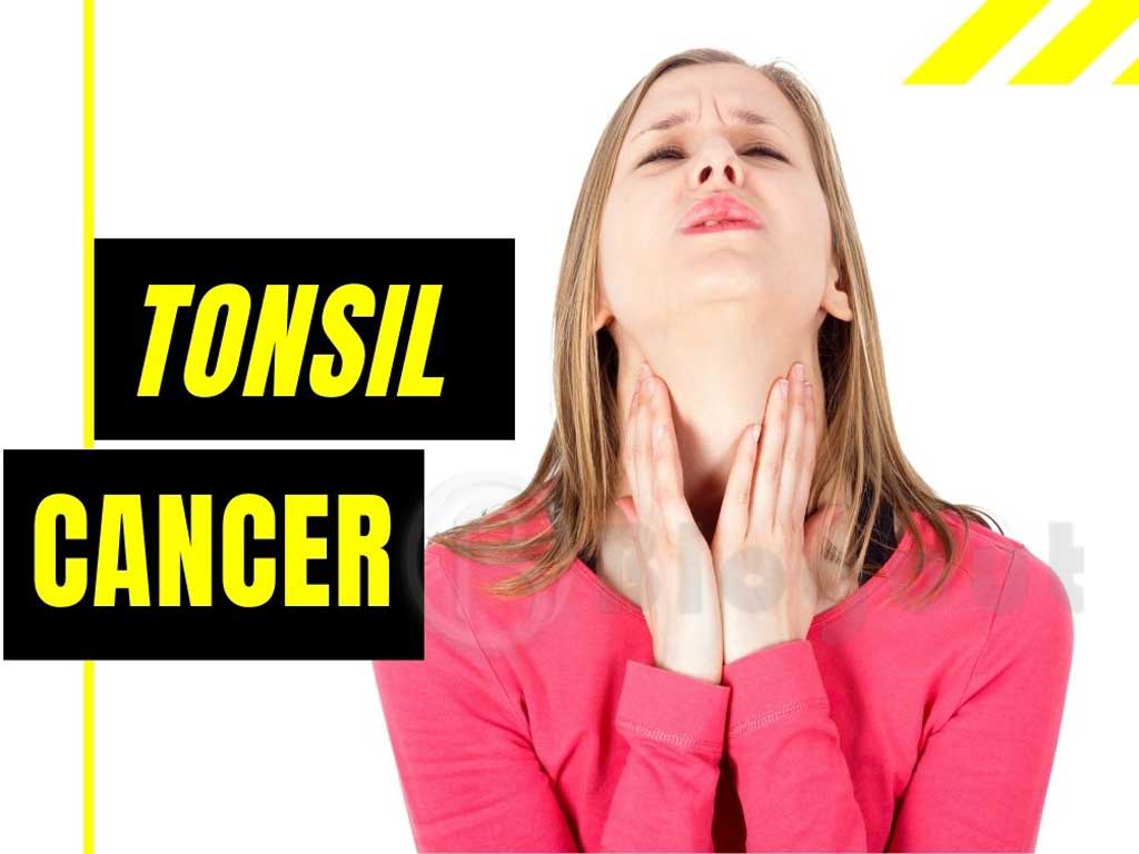 Tonsil Cancer