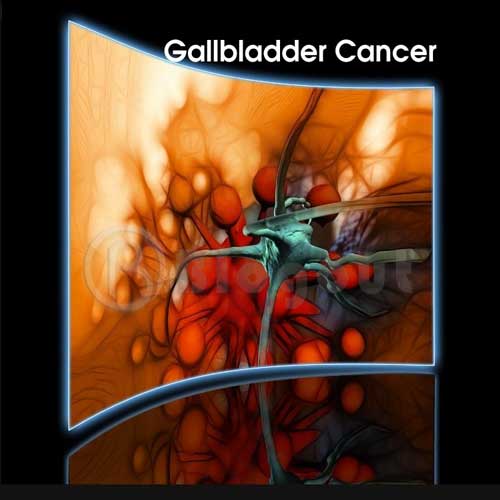 What is Gallbladder Cancer