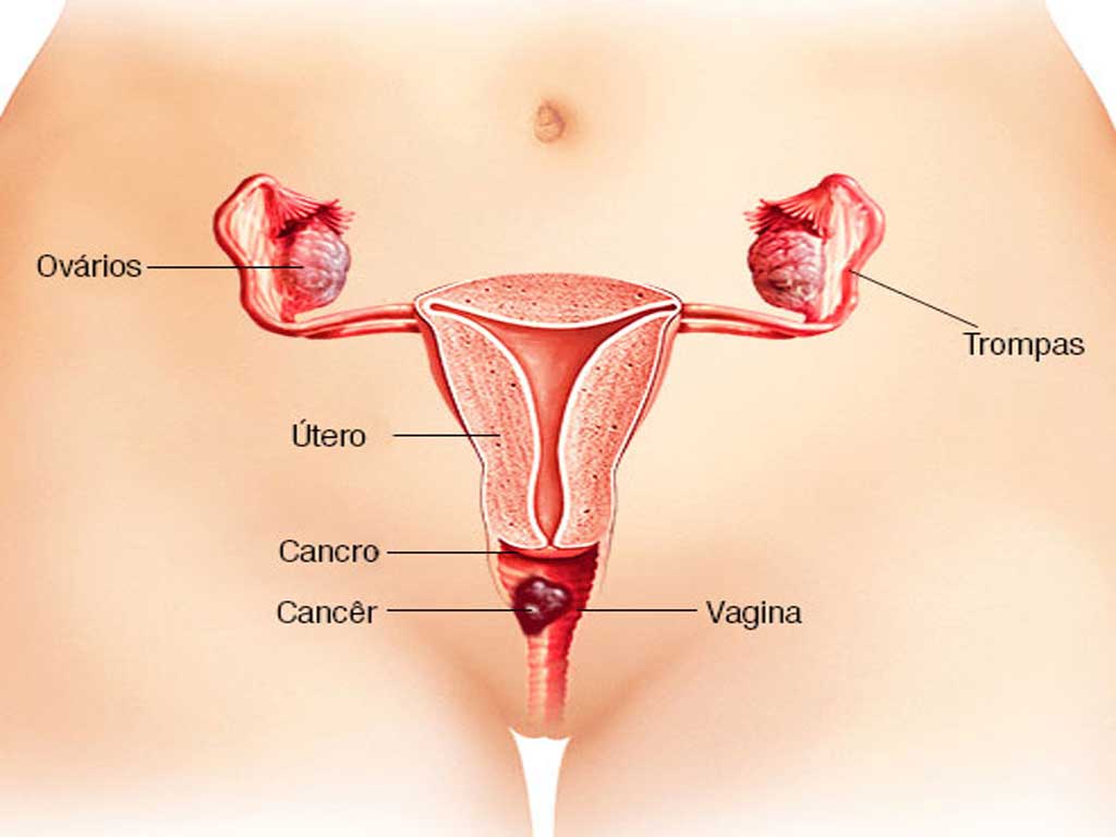 Vaginal Cancer